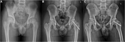 Analysis of risk factors for difficult implant removal in children with slipped capital femoral epiphysis treated by cannulated screws
